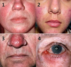 Rosacea 2.jpg