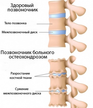 Остеохондроз.jpg