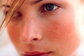 Rosacea 1.jpg