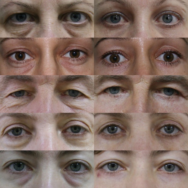 Файл:Blefaropl001.jpg