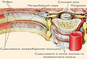 Фото к статье Межреберная невралгия 4.jpg