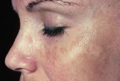 Pigmentation 1.jpg